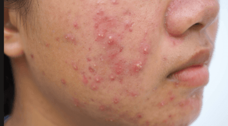 Acne and skin care consultation for private treatment advice